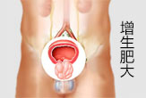 前列腺增生