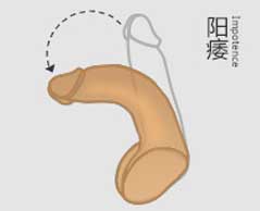 阳痿