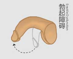 勃起不坚