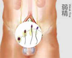 弱精