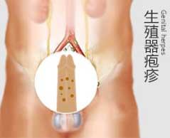 疱疹