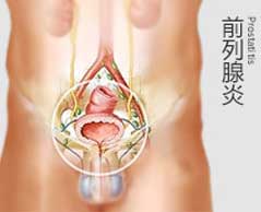 前列腺炎