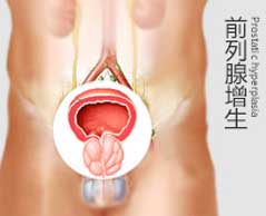 增生肥大