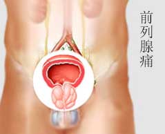 前列腺痛