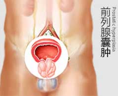 前列腺囊肿
