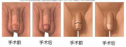 包皮术前术后效果图