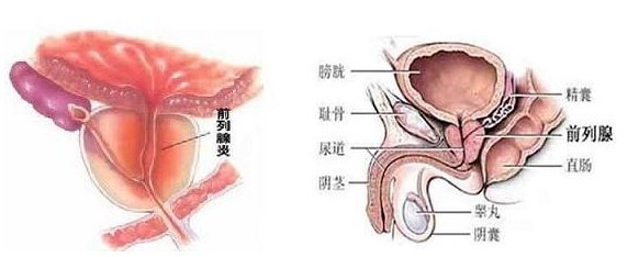 治疗前列腺炎多少钱