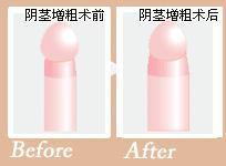 阴茎短小如何是好?