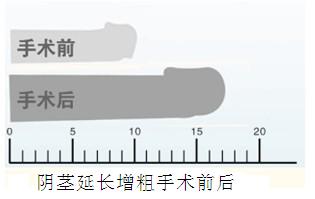 阴延长增粗手术费贵吗?