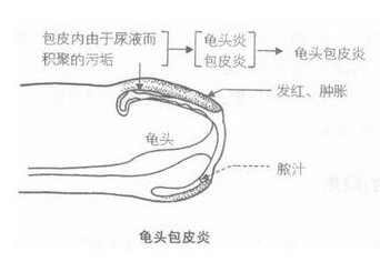 包皮红肿发痒是什么原因?有危害吗?