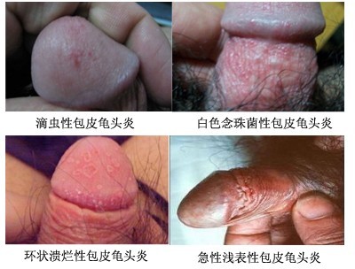 包皮龟头炎症状有哪些?