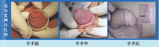 番禺哪家医院做包皮手术