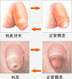番禺沙湾做包皮手术多少钱?