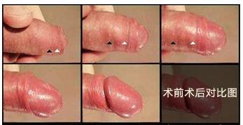广州化龙那个医院做包皮好点啊